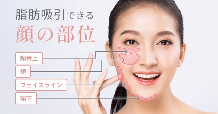 脂肪吸引できる顔の部位 頬骨上/頬/フェイスライン/顎下