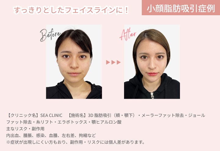 すっきりとしたフェイスラインに！小顔脂肪吸引症例