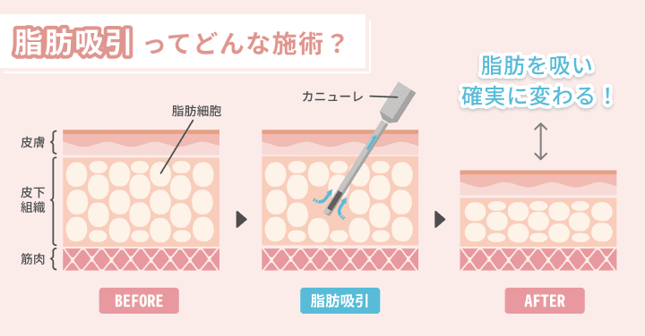 脂肪吸引ってどんな施術？