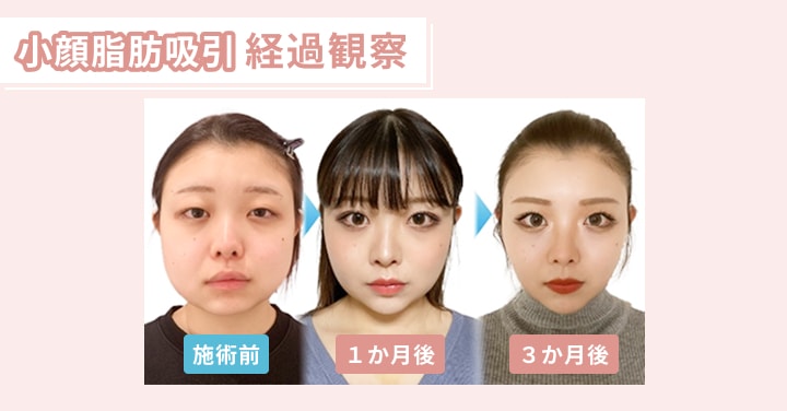小顔脂肪吸引 経過観察